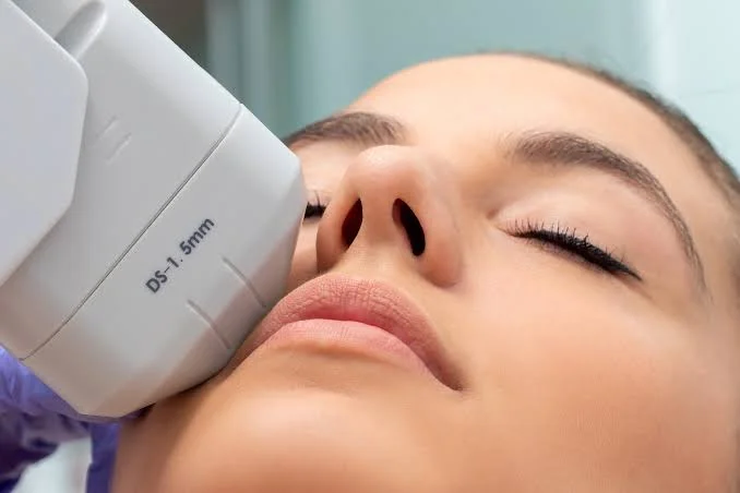HIFU: niet-chirurgische facelift