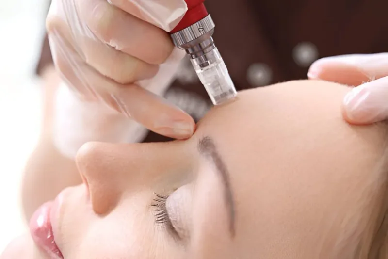 Microneedling gezicht: wat moet je weten